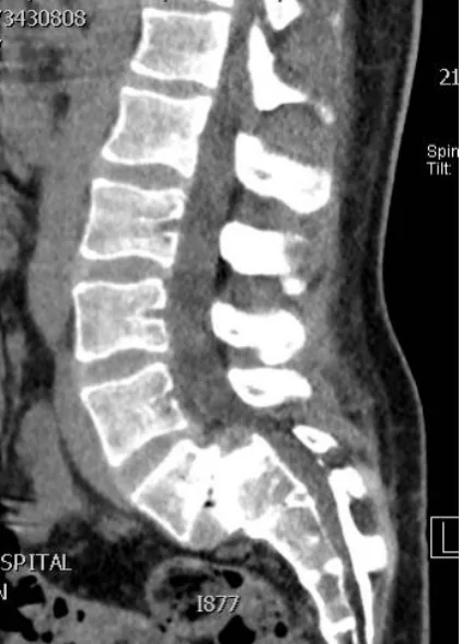 spondylolysi